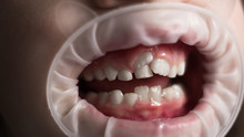 Adult Permanent Teeth Coming In Front Of The Child's Baby Teeth: Shark Teeth.