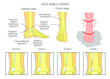 Illustration of Mechanism of formation of a High ankle sprain  (Syndesmotic Sprain) and Grades of high ankle sprain with external and skeletal (lateral and front) view of an ankle.