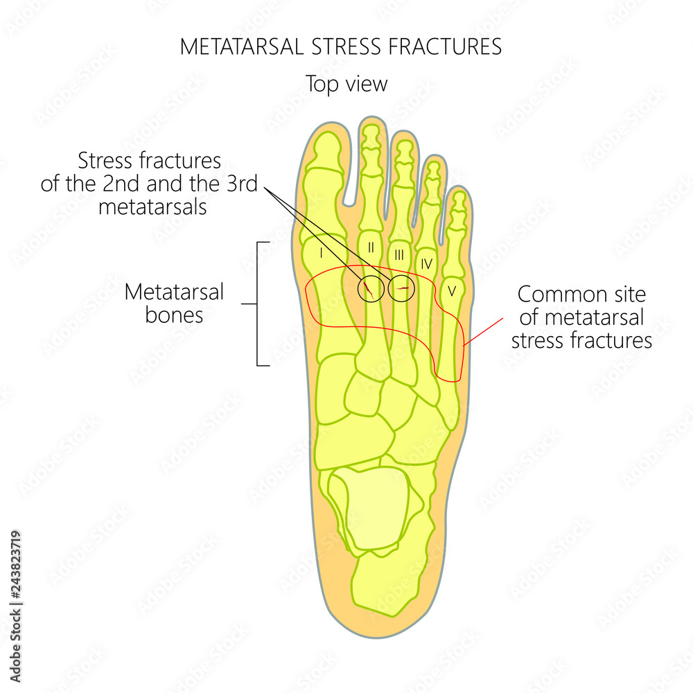 Metatarsal Injuries Illustration (Diagram) of Metatarsal Stress fractures in the foot ...