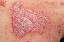 Detail Of Psoriatic Skin Disease Psoriasis Vulgaris With Narrow Focus, Skin Patches Are Typically Red, Itchy, And Scaly