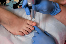 Toenail Fungus Treatment With Foot Laser At Laser Nail Therapy Clinic. - Image