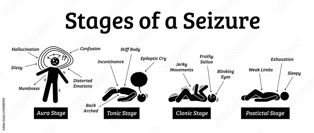 Stages and phases of a seizure. Illustrations depicts the phases when a person get a seizure which are the aura, tonic, clonic, and postictal stages. - obrazy, fototapety, plakaty 