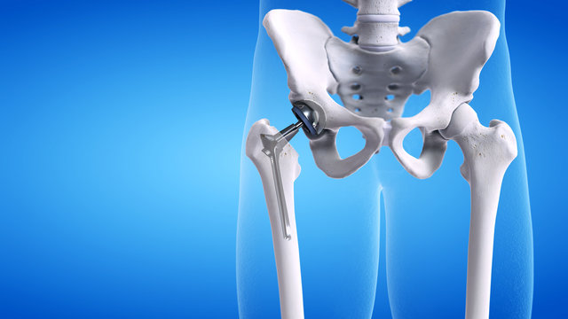 3d rendered medically accurate illustration of a hip replacement