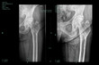 Femoral head necrosis and progress of the healing process of greater trochanter fracture
