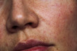 pigmentation on the face. red spots