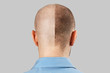 Man before and after hair loss, transplant on background. back view