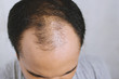 Close up young man concerned with serious hair loss. bald head thin and scalp and broken hair. concept healthcare