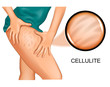 cellulite on a woman's thigh