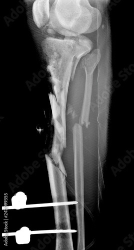 Radiografia Fractura De La Tibia Y Perone Buy This Stock Photo And Explore Similar Images At Adobe Stock Adobe Stock