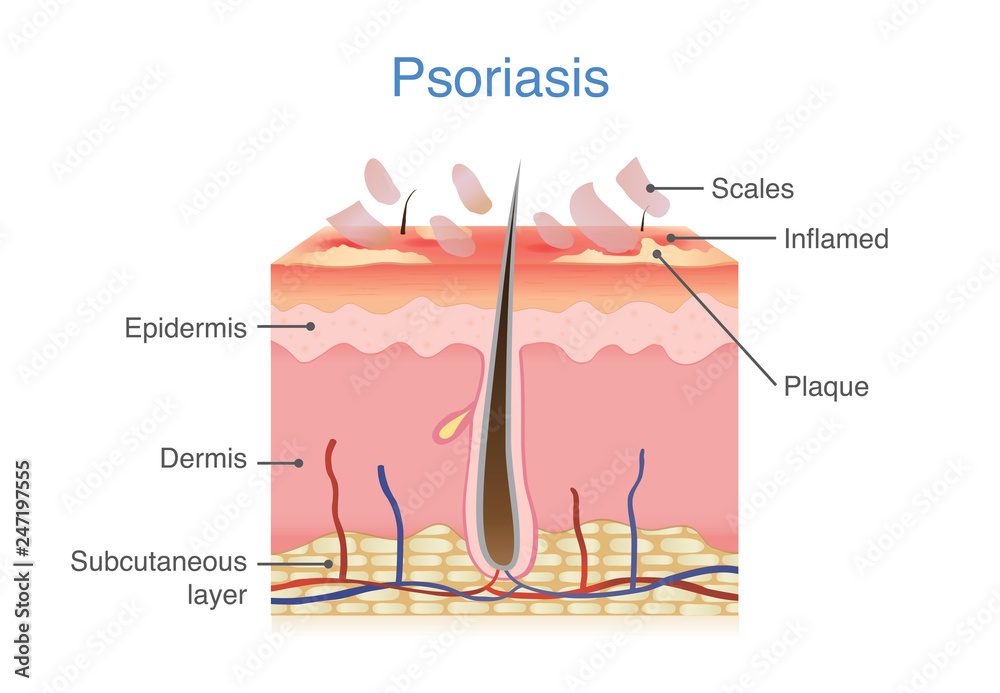 Illustration of human skin layer when plaque psoriasis signs and symptoms appear. - obrazy, fototapety, plakaty 