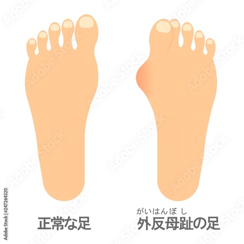 外反母趾の足と正常な足stock Illustration Adobe Stock