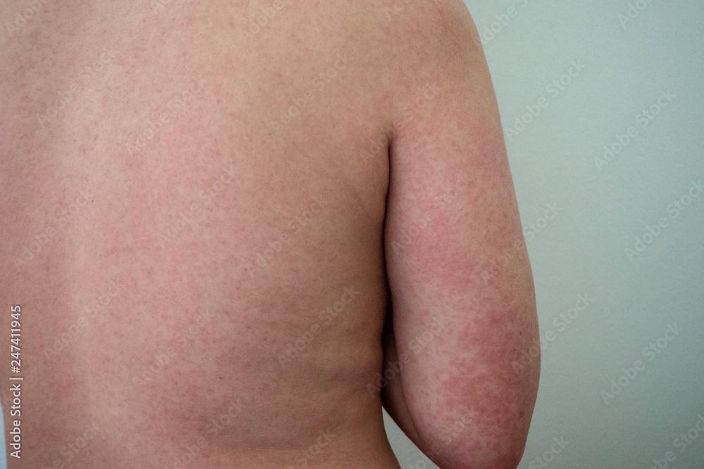 An exanthem is a rash or eruption on the skin. 