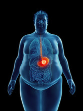 Illustration Of An Obese Man's Stomach Tumor