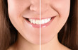 © New Africa - Smiling young woman before and after teeth whitening procedure, closeup