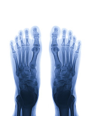 Poster - Radiographic image or film x-ray of both foot AP view . Gouty arthritis concept