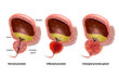 Benign Prostatic hyperplasia (BPH). Inflamed prostate and Enlarged prostate gland