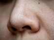 close up wide pores skin on dry face of Asian woman, Female nose and cheek skin problem, large pores, whitehead and blackhead pimple, nose