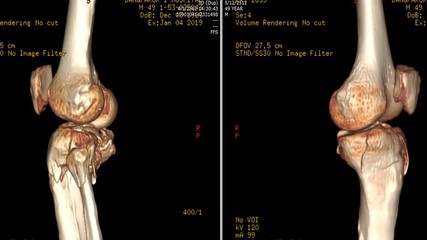 Poster - ct scan image of left knee 3d rendering image showing fracture of leg or tibia bone.