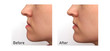 Orthognathic Surgery. Jaw Surgery. Malocclusion