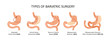 Types of bariatric surgery. Stomach reduction