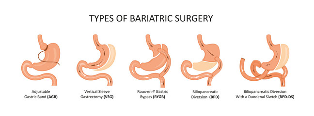 Types of bariatric surgery. Stomach reduction