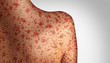 canvas print picture Measles Concept