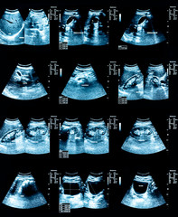 Ultrasound Scan Image of abdomen. Medical diagnostic