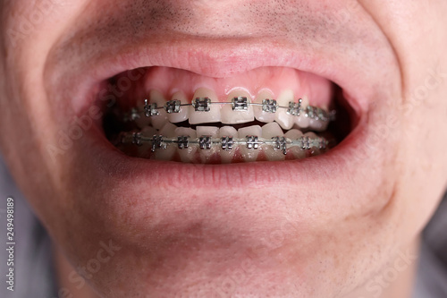 Metal Orthodontic Braces On Crooked Ugly Teeth Close Up Ugly Smile Dental Concept Medicinal Alignment Of Teeth Brackets Orthodontist Stock Foto Adobe Stock