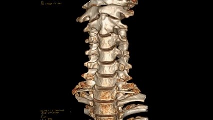 Poster - CT SCAN of Cervical  Spine or CT C-spine    3D rendering image  Rotating on the monitor . Medical technology concept.