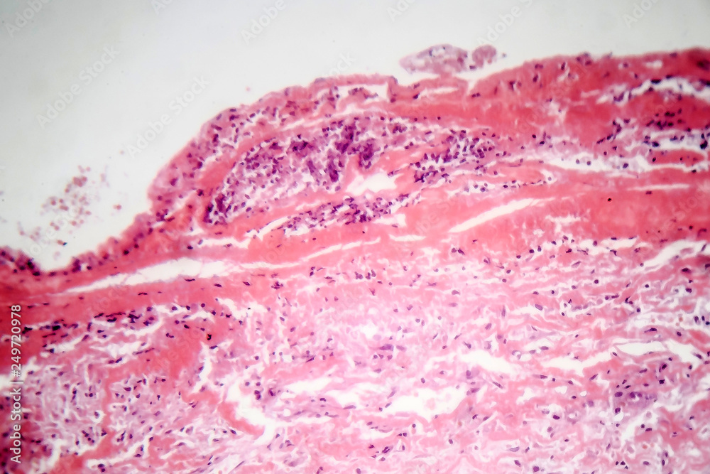 Histopathology of tuberculous pleurisy, light micrograph, photo under ...