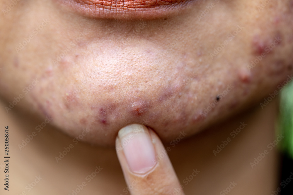 Backgrounds of lesions skin caused by acne on the face in the clinic ...