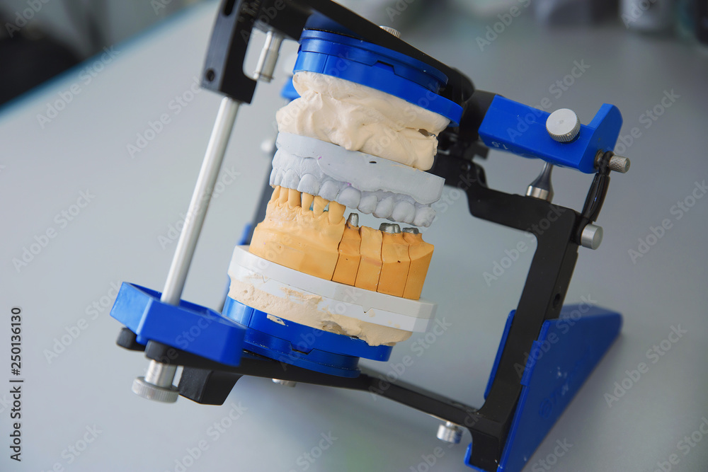 Plaster model of the upper and lower jaw of the patient of dental ...