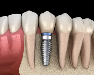 Premolar tooth recovery with implant. Medically accurate 3D illustration of human teeth and dentures concept