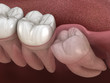 © Alex Mit - Healthy teeth and wisdom tooth with mesial impaction . Medically accurate tooth 3D illustration