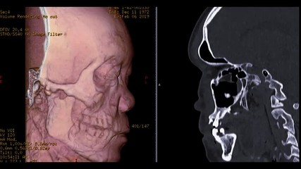 Poster - CT scan of facial bone 3D rendering image  from case head injury comparison 3D image vs sagittal image . realistic face .