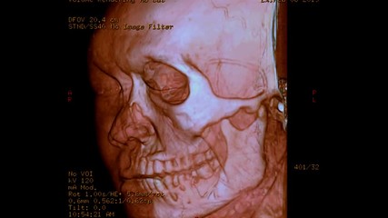 Poster - CT scan of facial bone 3D rendering image from case head injury. realistic face .