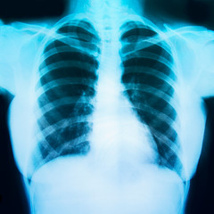 Naklejka na meble  Chest x ray film of a patient