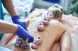 Healing bloodletting, hijama or phlebotomy. Hajam master conducts cupping therapy on a young woman. Islamic medicine