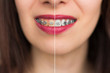 © vladim_ka - Teeth brackets whitening before after. Woman Teeth brackets  Before and After Whitening. Happy smiling woman brackets  face close up. Dental health Concept. Oral Care concept