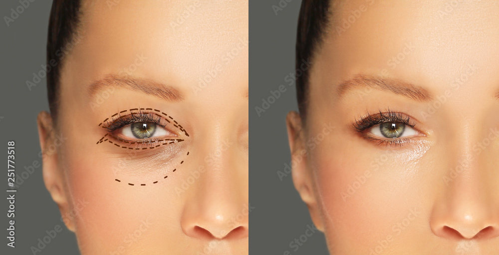 Lower and upper  Blepharoplasty.Marking the face.Perforation lines on females face, plastic surgery concept. - obrazy, fototapety, plakaty 