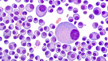 Multiple Myeloma Awareness: Bone Marrow Aspirate Cytology Of Multiple Myeloma, A Type Of Bone Marrow Cancer Of Malignant Plasma Cells, Associated With Bone Pain, Bone  Fractures And Anemia.