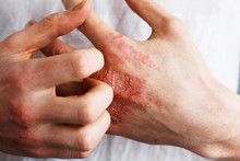 Man Scratch Oneself, Dry Flaky Skin On Hand With Psoriasis Vulgaris, Eczema And Other Skin Conditions Like Fungus, Plaque, Rash And Patches. Autoimmune Genetic Disease.