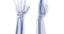 X-ray Image Of Left Wrist Joint Ap And Lateral View. Rheumatoid Arthritis Concept.