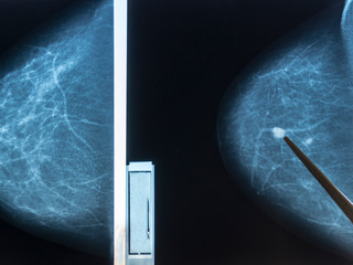 Mammography. The doctor examines pictures of a patient with fibroadenomatosis.