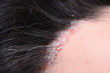Psoriasis. Hairy part of the head. Plasma injection. Treatment of zabolivanie plasma human blood.