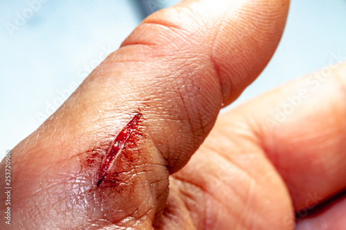 Fotografía One photo of a series of photos taken of a fresh bleeding cut development over a