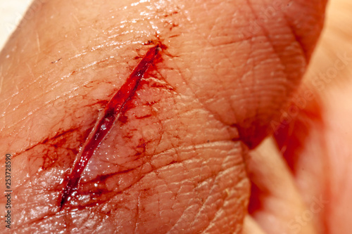 Fotomural One photo of a series of photos taken of a fresh bleeding cut development over a