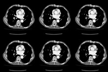 Computed Tomography CT Whole Abdomen In Axial. Part Nine
