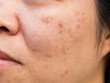 Problems facial skin is acne and blemishes.