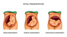 Presentation Of The Fetus. Norm And Pathology